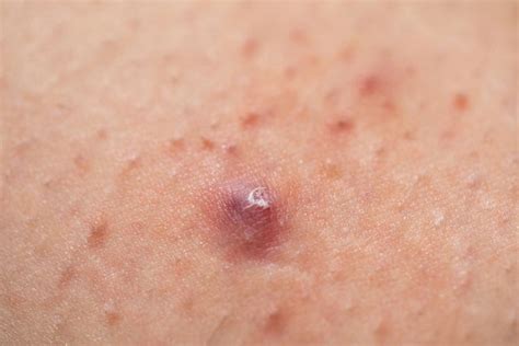 Foliculitis Qué Es Causas Y Tratamiento [fotos] Tua Saúde