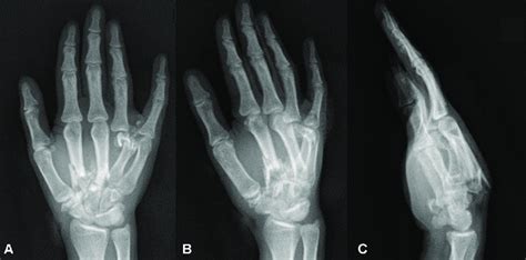 Three View X Ray Of The Right Hand A Anteroposterior View B Oblique