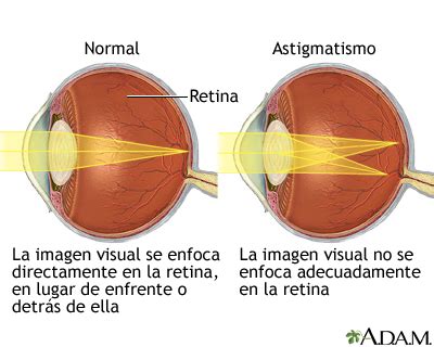 Como Se Escreve Astigmatismo