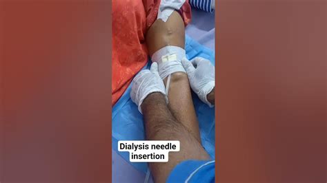 Dialysis Needle Insertion Youtube