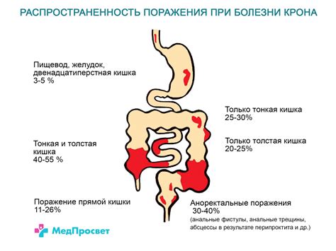 Болезнь Крона - симптомы, диагностика и лечение | Клиника МедПросвет