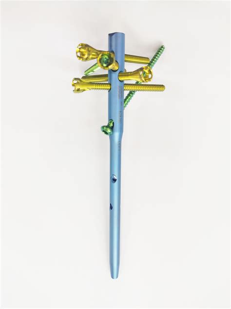 Orthopedic Proximal Humerus Nail Implant and Instruments