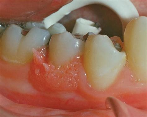 Hpv Warts On Gums