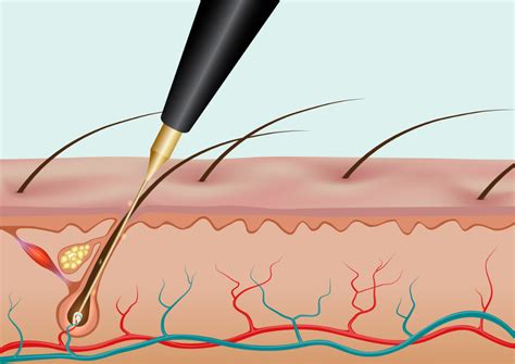 Electrolysis Beard Removal Cost Real You Electrolysis