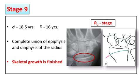 Skeletal Maturity Indicator Short Ppt
