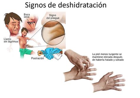 Deshidratación - UniversalPharmacist Speaker