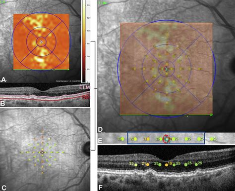imaging analysis  orl thickness map obtained  heidelberg