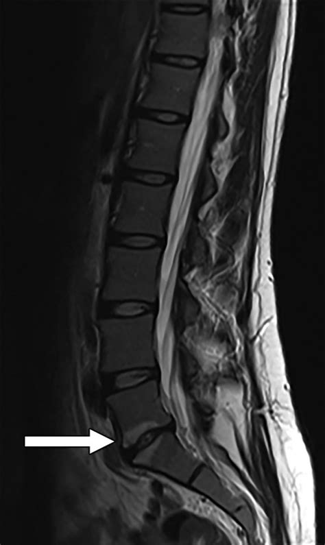Modic Type 1 Vertebral Endplate Changes: Injury, Inflammation, or ...
