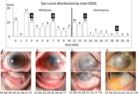 Eye Count Distribution By Total Ocular Surface Grading Score Osgs And Download Scientific