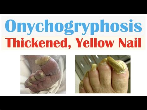 Onychogryphosis Pictures