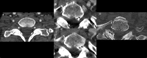 Frontiers | Computed tomography-based investigation of degenerative