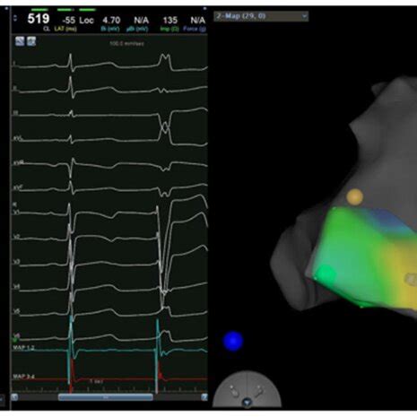 Left Activation Mapping Right Pace Mapping Is Used To Verify That