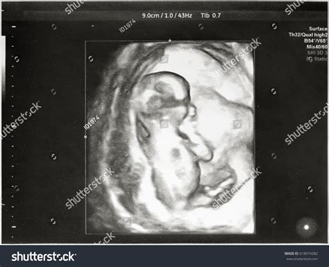 Ultrasound Fetus 9th Month Pregnancy Stock Photo 618974282 | Shutterstock