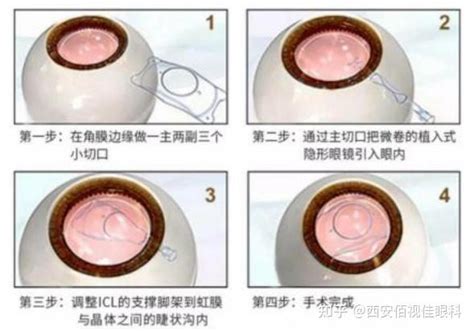 3分钟带你了解全飞秒、半飞秒、精雕绿分秒、晶体植入！ 知乎