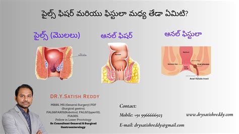 Demystifying Anal Health Piles Fissures Fistulas Differences Symptoms And Treatments