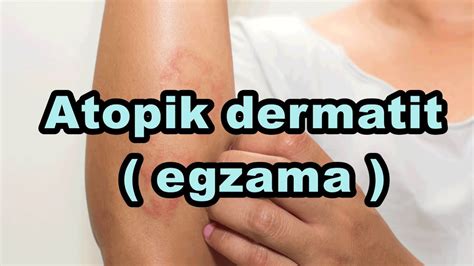 Atopik Dermatit Egzama Binaural Isochronic Enerji Frekansı