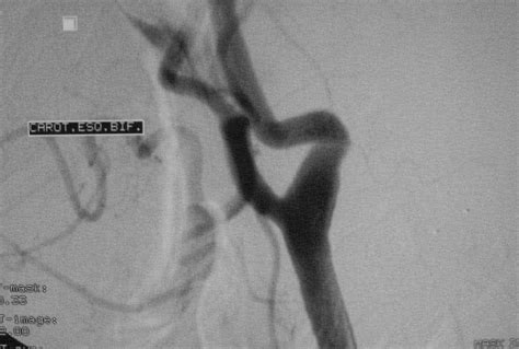 Bypass Arterial Saiba Como Essa Cirurgia Pode Melhorar A Qualidade De