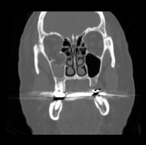 Blowout fracture - wikidoc