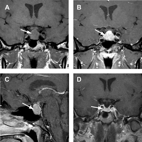 Neuroimaging of the Pituitary Gland - Radiologic Clinics