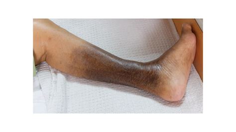 Venous Leg Ulcers And Comorbidities WoundSource