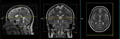 MRI Brain Protocols , Planning , Positioning and Indications