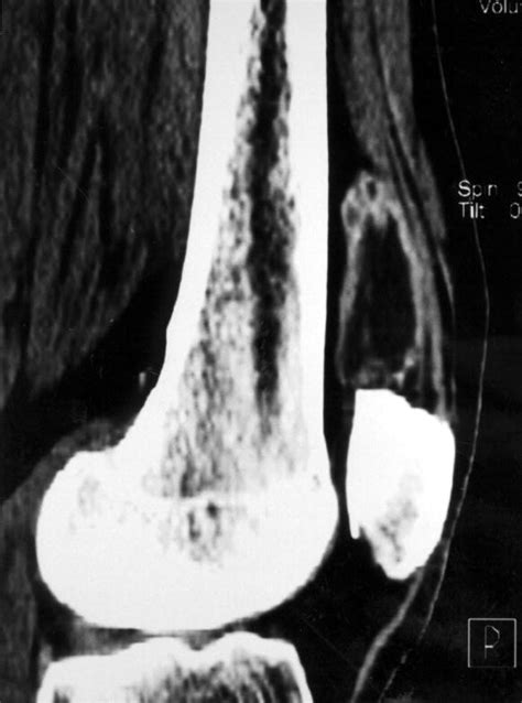 Isolated suprapatellar bursitis: Computed tomographic and arthroscopic ...