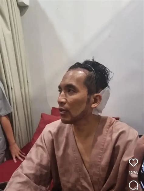 Desta Jalani Transplantasi Rambut Di Klinik Tompi Merasa Jidat Kelewat