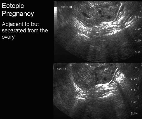 Adnexal Signs In Ectopic Pregnancy