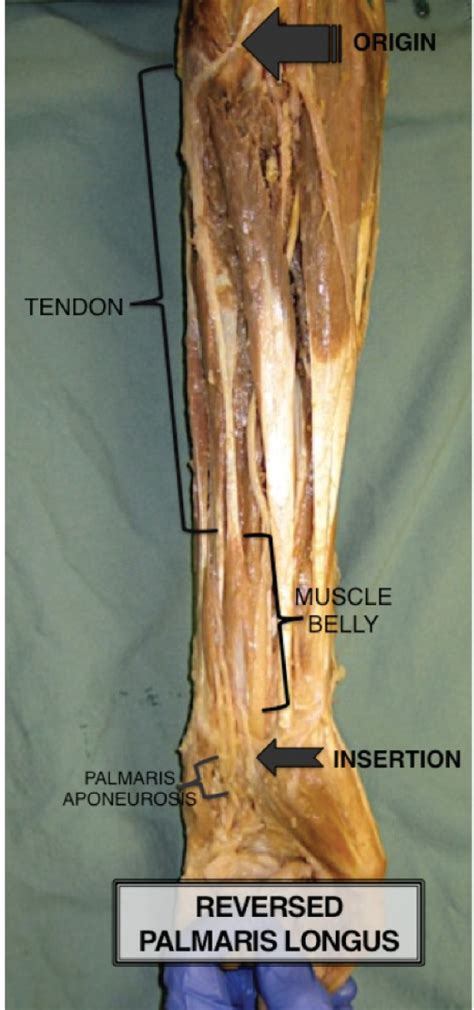 Palmaris Longus Cadaver