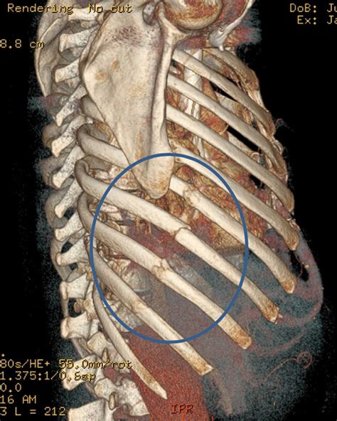 Rib Fracture Guidance At Patrick Sharp Blog