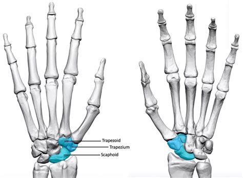 Tri-scaphoid/STT Joint Osteoarthritis – Lothian Virtual Hand Clinic