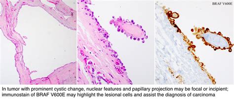 Pathology Outlines Papillary Thyroid Carcinoma Classic