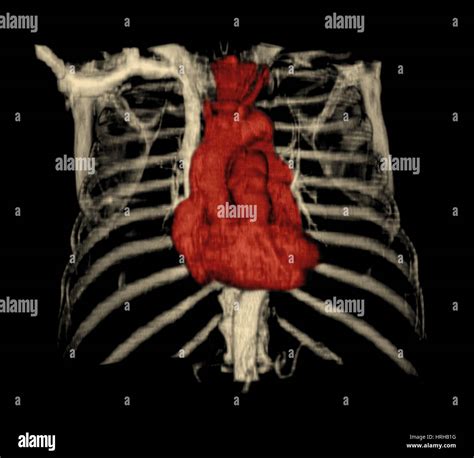 3D CT Reconstruction Of Heart Stock Photo Alamy