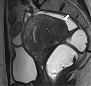 Mri For Adenomyosis A Pictorial Review Insights Into Imaging Full Text