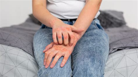 Artrite psoriasica cos è e come si cura Plantadea