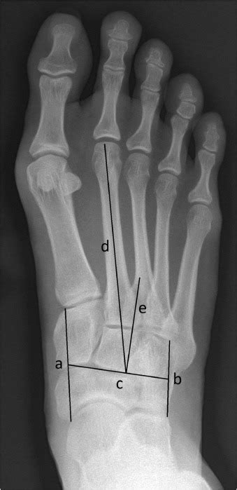 The Syndesmosis Procedure Correction Of Hallux Valgus Feet Associated