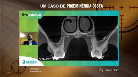 O Que É Proeminência Óssea - O Que é Proeminência óssea - RETOEDU