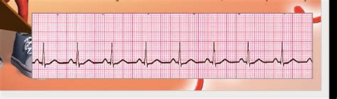 Acls Rhythms Flashcards Quizlet