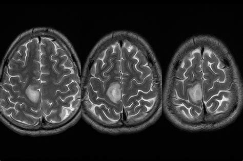 Parietal Lobe Mri