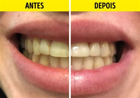 Experimentamos Formas Caseiras De Clarear Os Dentes O Bicarbonato De