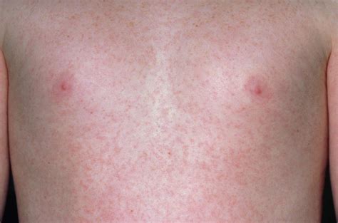 Rubeola Virus