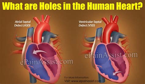 holes   human heart