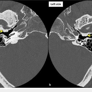 (PDF) Bilateral External Auditory Exostoses Causing Conductive Hearing ...