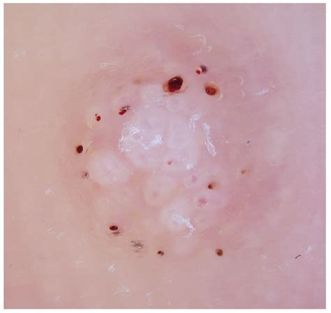 Anatomy Of A Wart