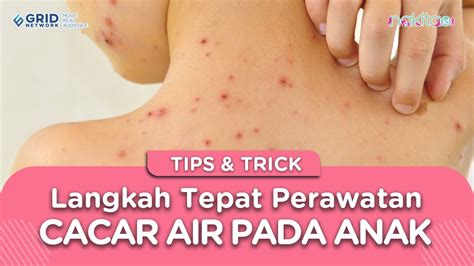 jangan sampai salah jalan  langkah tepat perawatan cacar air