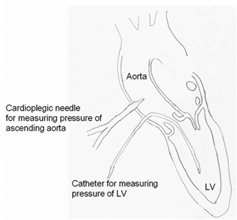 A Method To Check Post Operaive Pressure Gradient By The Surgeon