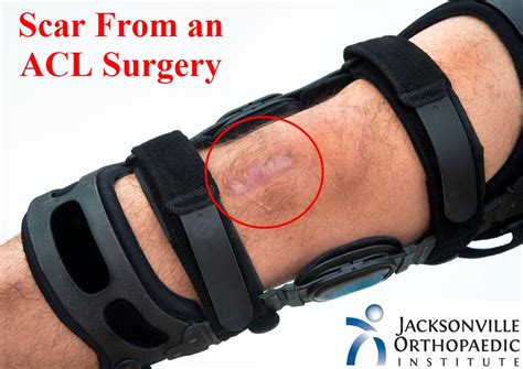 What Is The Best Treatment For A Scar After Acl Surgery Joi