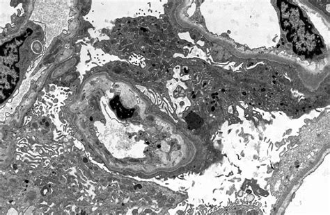Pathology Outlines - COVID-19 associated kidney injury