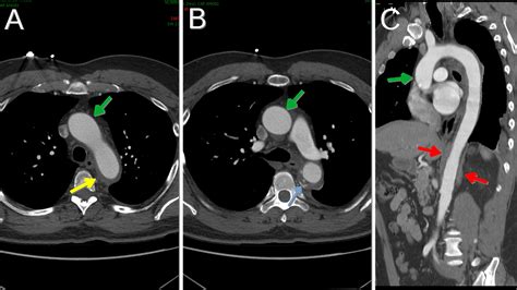 Aortic Intramural Hematoma