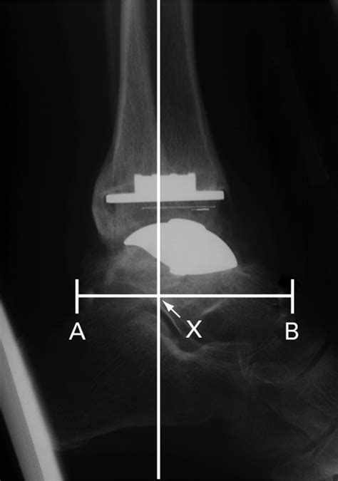 Total Ankle Replacement Bone Joint